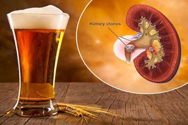 By drinking beer, the biggest kidney stone gets removed quickly. - New  Times Of India