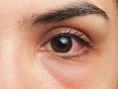 Are your eyes pointing to an underlying disease?  Top 5 signs to watch for |  Health Tips & News