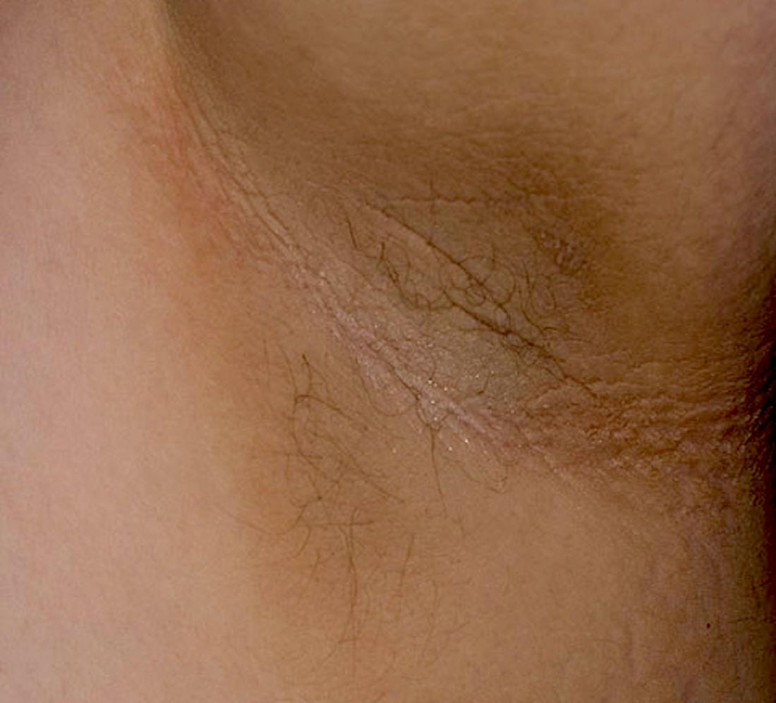 Darkening of underarms: Causes, treatment and prevention