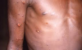 WHO has warned that if monkeypox is not controlled ahead