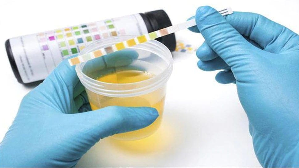 Urine infection: If the color of urine appears like this, take care immediately!  Do this quickly
