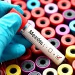 measles cases mumbai
